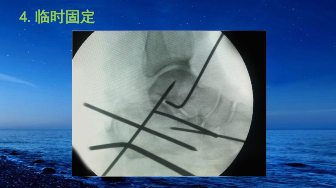 今天分享一組來自@歸海依刀的精美課件,對跟骨骨折用跗骨竇切口手術