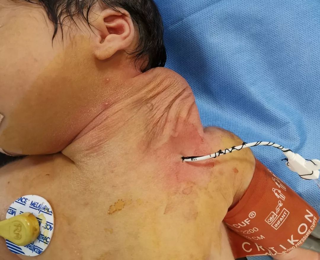 对出生仅3天患危重颈部淋巴管畸形的新生儿成功实施经皮硬化微创手术