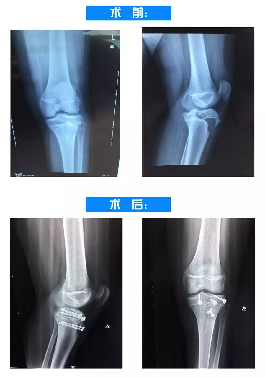 骨骺线膝盖图片