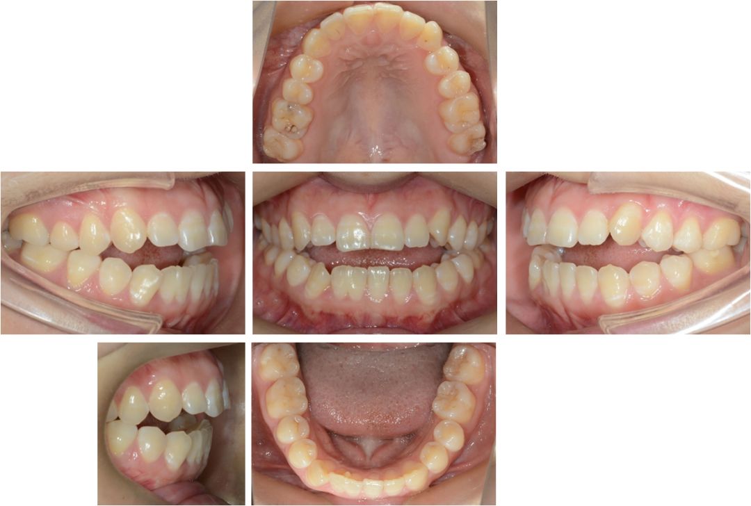 隱形矯治十強病例丨微種植釘輔助壓低後牙糾正開合