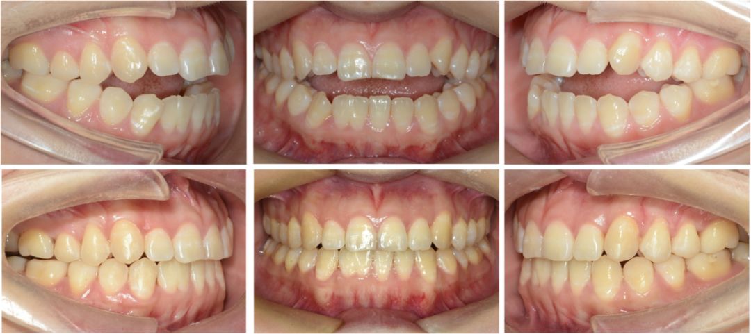 隐形矫治十强病例丨微种植钉辅助压低后牙纠正开合