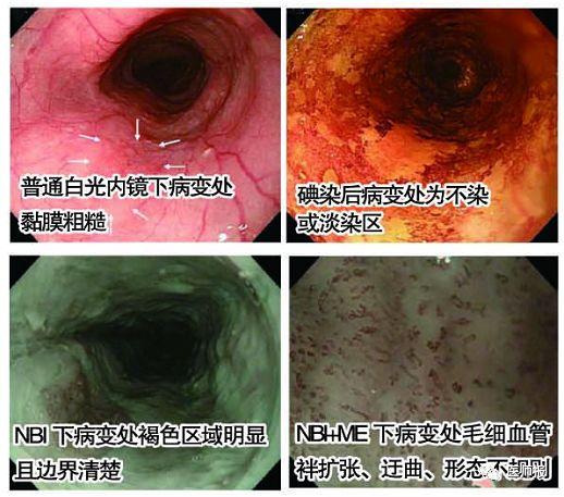 分享|困惑:慢性咽炎與食管癌有關係嗎?_胃鏡