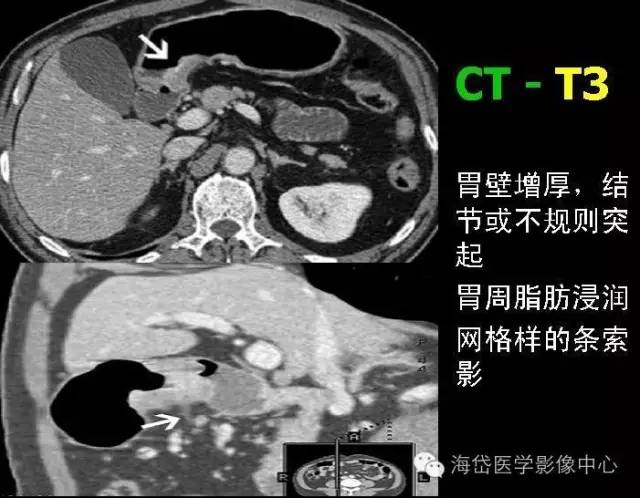 胃癌ct图片 片子图片