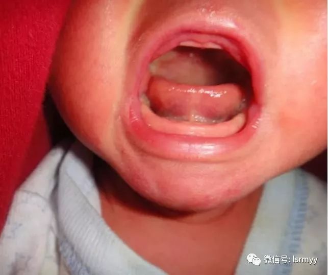 刚出生宝宝的舌头图片图片