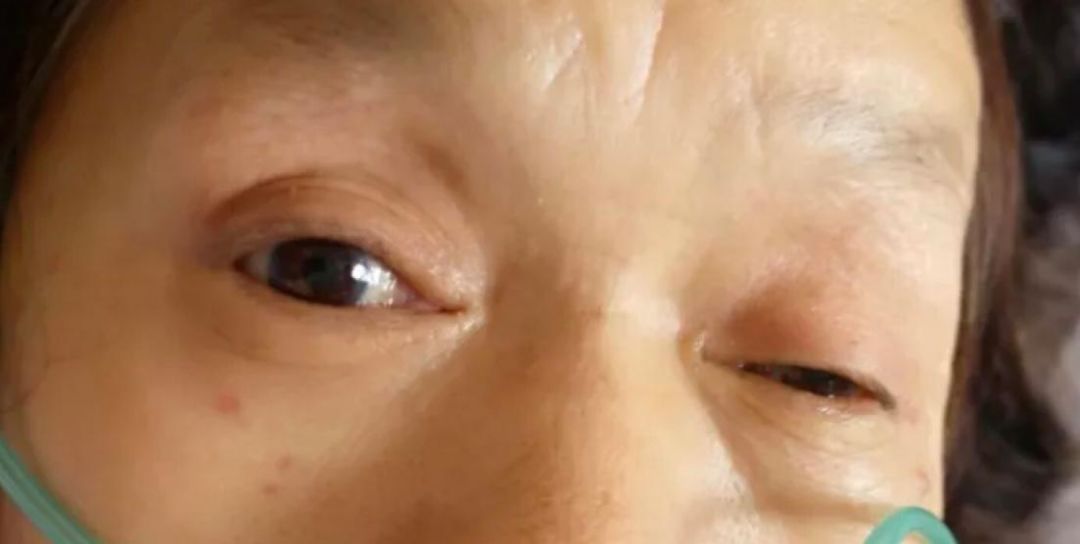 沒想到火炬區67歲阿婆眼睛痛原來腦中有炸彈送10積分