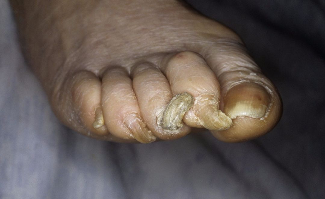 癌症病人脚趾甲图片图片