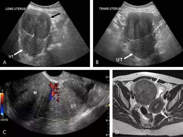 实用子宫肌瘤的超声诊断和鉴别