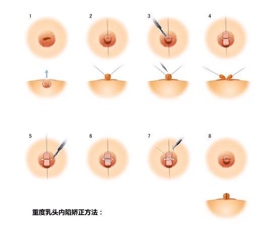 导致母乳喂养困难的问题有很多,乳头凹陷是其中之一