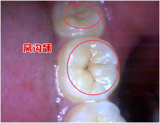 窩溝齲一定要補牙嗎原創