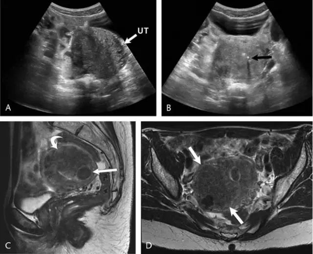 实用 子宫肌瘤的超声诊断和鉴别