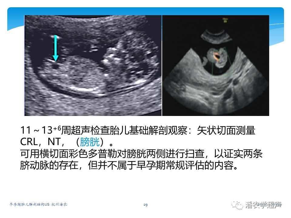 【超声微课堂】早孕期胎儿解剖结构超声检查及相关问题:头臀长,头部