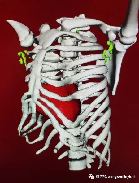 全球第5例窒息性胸廓發育不良綜合徵jeune綜合徵根治手術成功