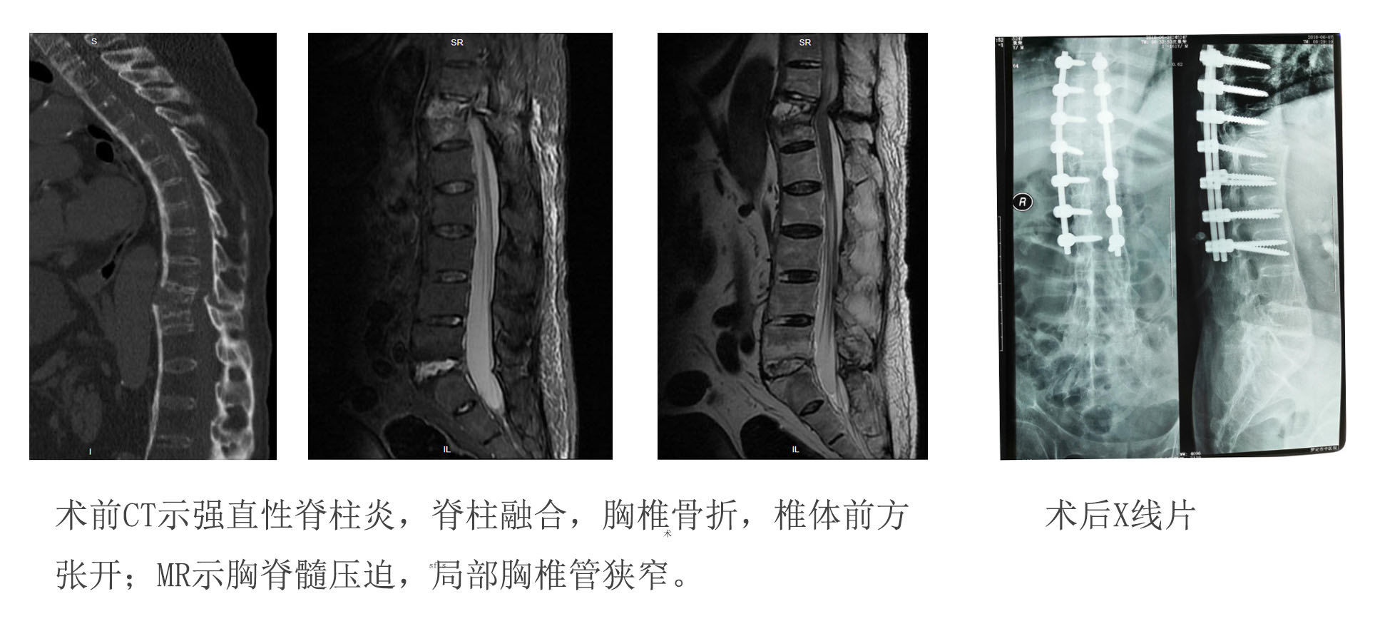 强直性脊柱炎发生胸椎结核并病理性骨折引起脊髓损伤原创