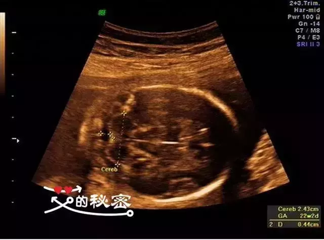 5,胎儿头部:颅骨环未见明显缺损,大脑回声可见,脑中线居中,两侧丘脑