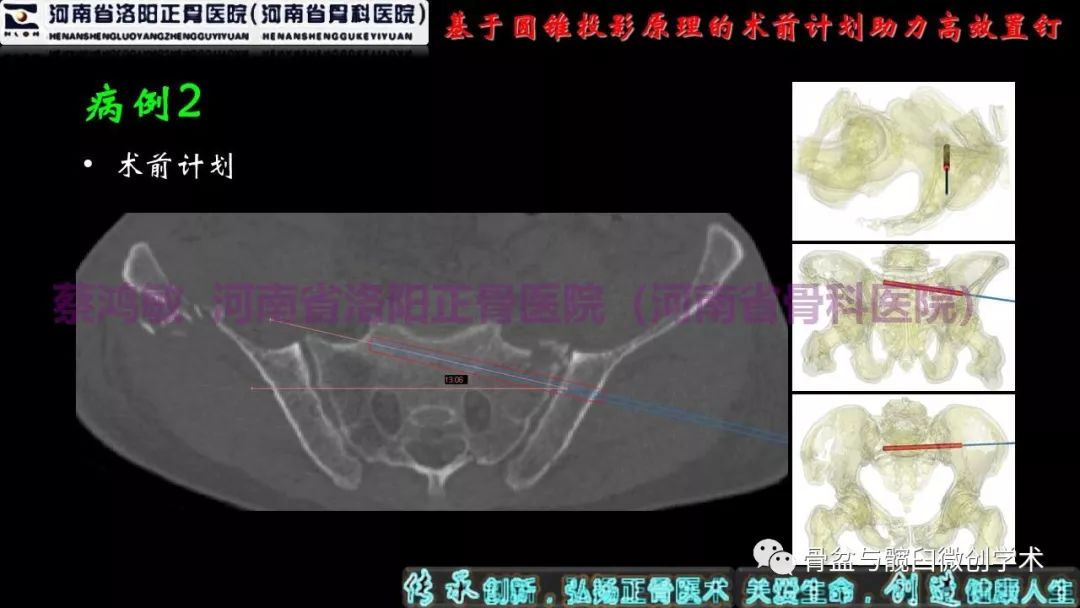 術中:插入導針,標準骶骨側位像上確立進釘點,調整導針位於骨盆橫斷面