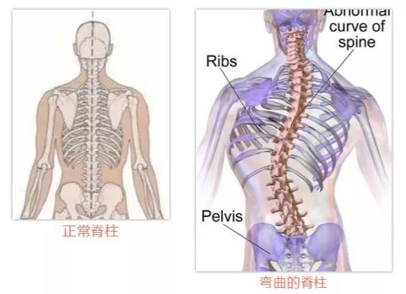 看,正常的脊柱像一颗笔直的松树,而退变性侧弯的脊柱像一颗弯曲的柳树