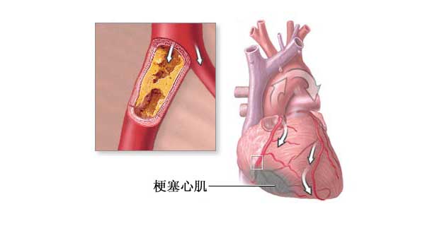 科普:冠心病患者支架術後心臟康復,你還應該