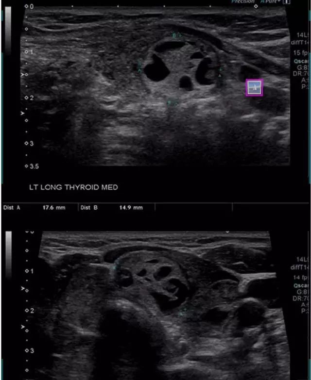 一文讀懂結節性橋本甲狀腺炎的超聲徵象