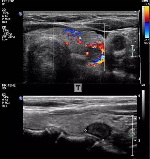 一文读懂:结节性桥本甲状腺炎的超声征象
