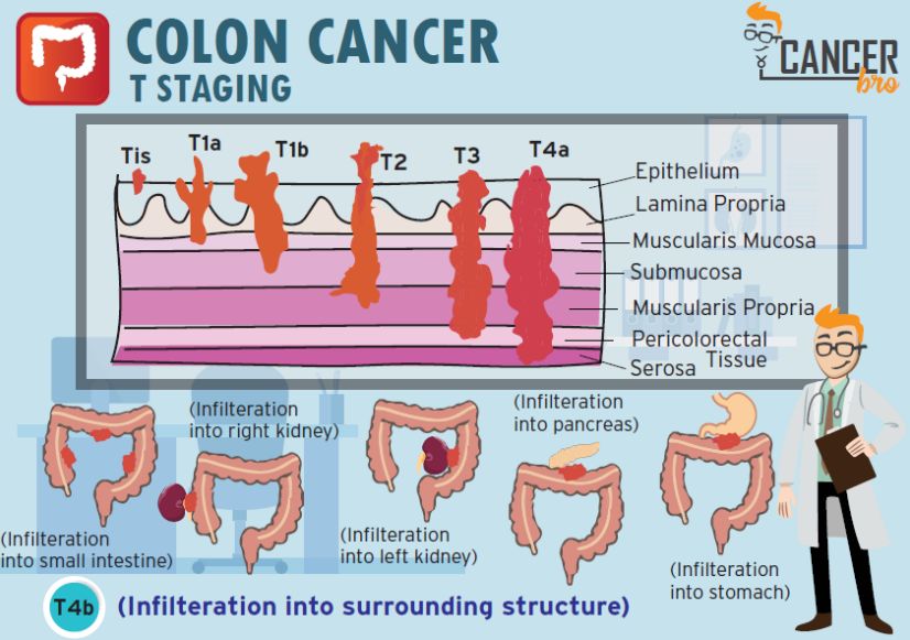 Dieta para personas operadas de cancer de colon