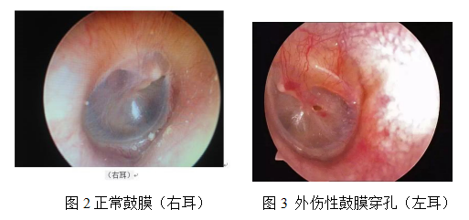 健康 正文 鼓膜,又称耳膜,是外耳道和中耳之间的一层结缔组织,呈半