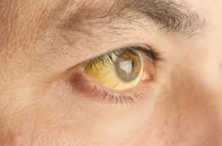 巩膜发黄巩膜也就是眼睛上发白的部分,如果肝脏出现了问题,那么对于