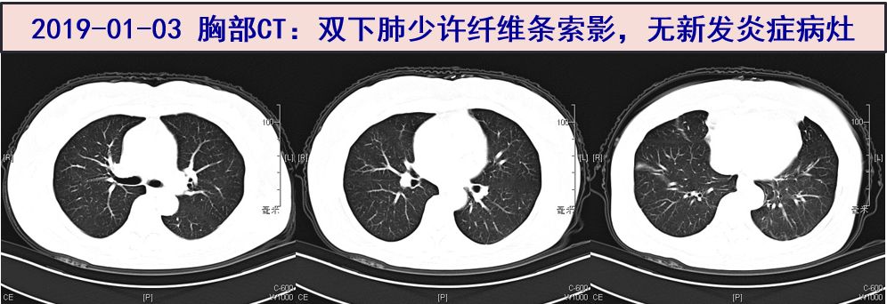 竇性心律 2.房性早搏三聯律【輔助檢查】gm試驗:0.