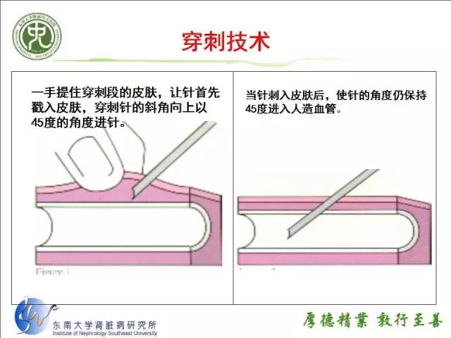 动静脉内瘘如何实施穿刺,视频和ppt保你学会!