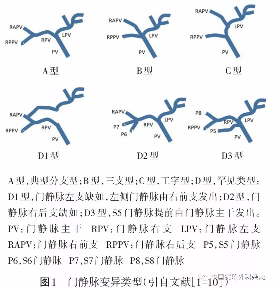 门静脉工字型图片