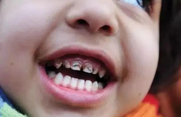 铅中毒牙龈图片图片