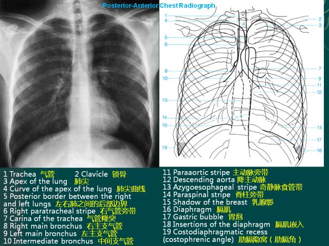 纵隔解剖   纵隔疾病x线诊断要点