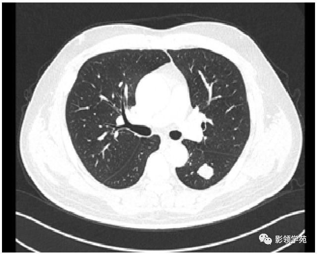 肺背段图片