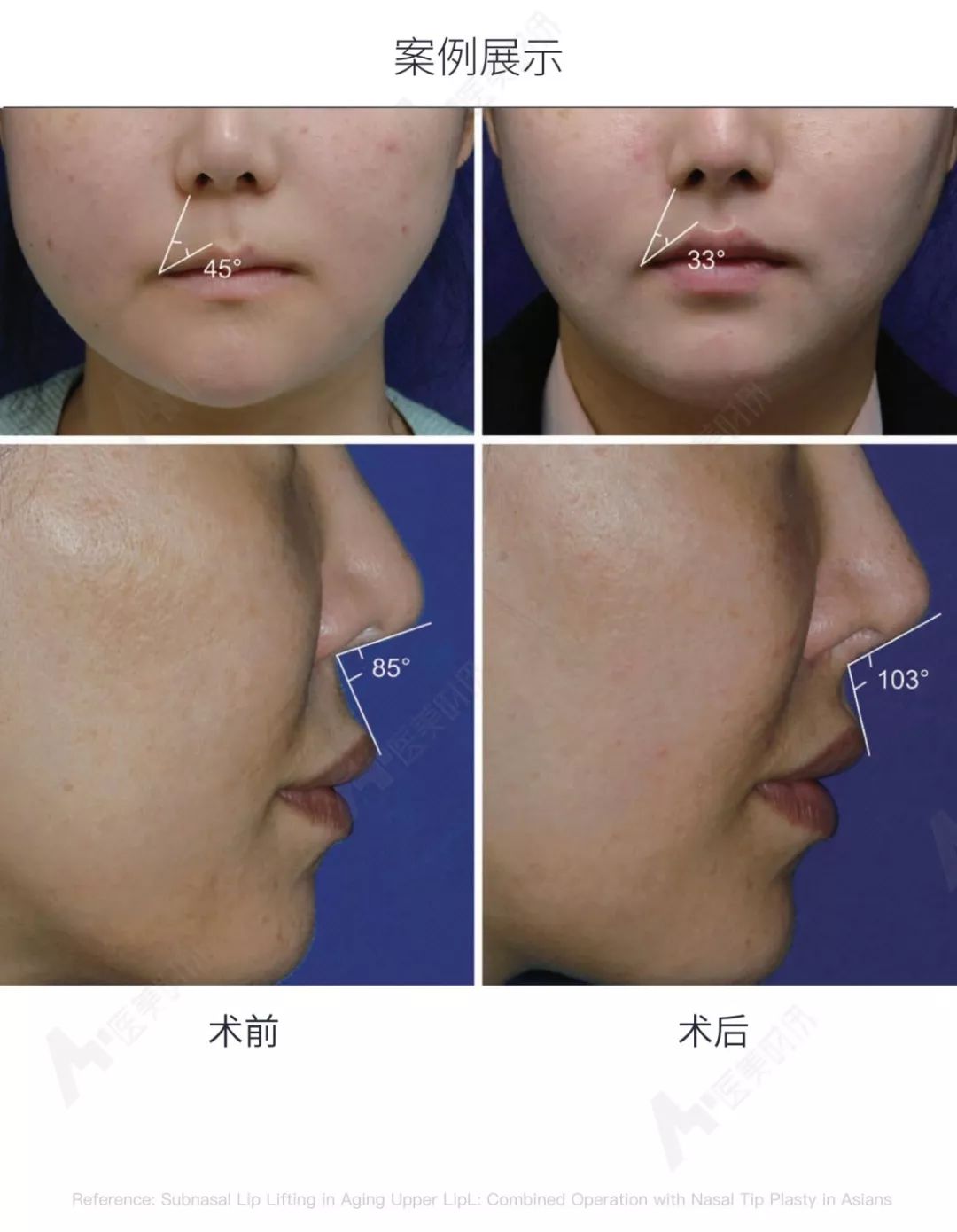 韩国人中缩短术同时提升上唇与鼻尖