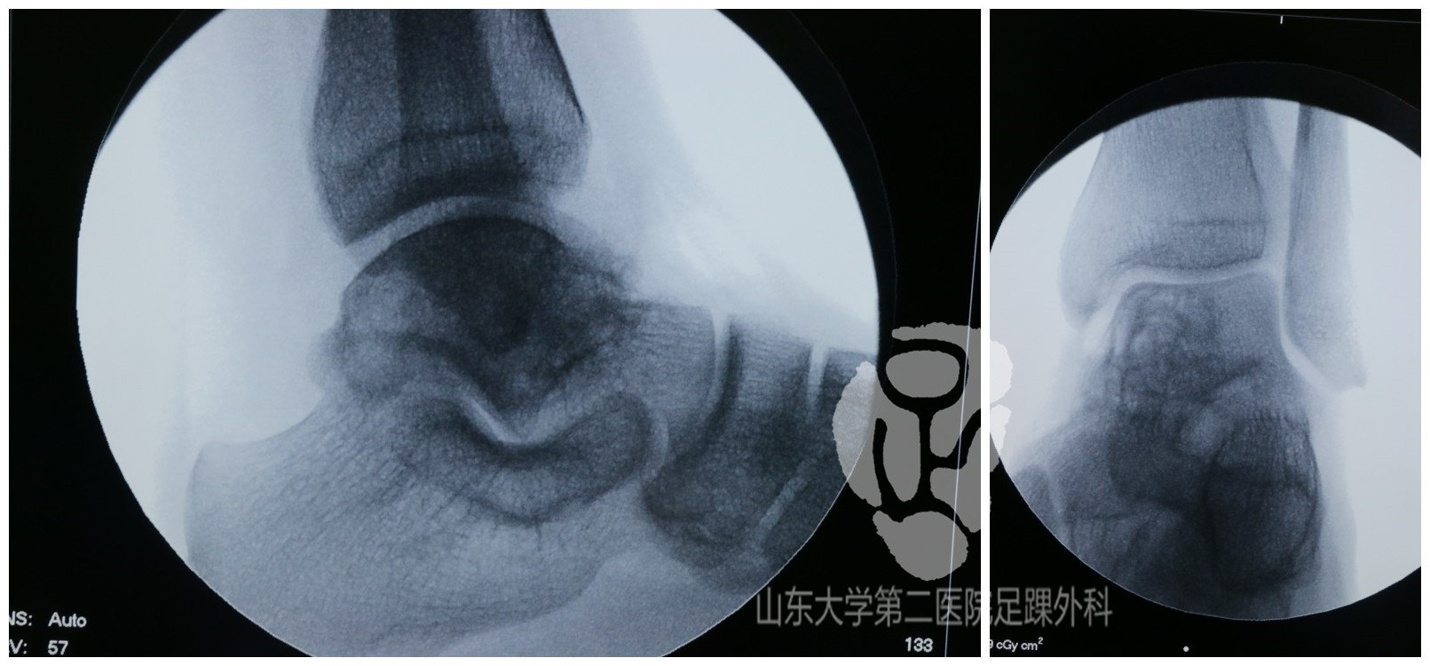 微創小切口治療距骨囊腫山東大學第二醫院足踝外科特色技術原創