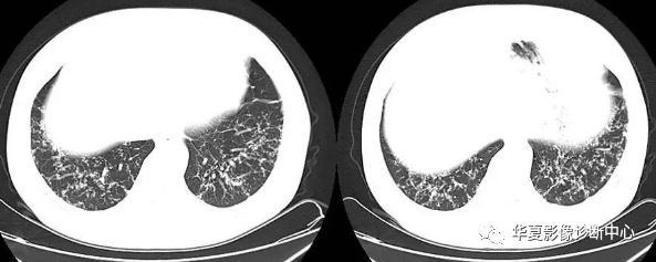 原發性氣管支氣管澱粉樣變( primarytracheobronchialamyloidosis