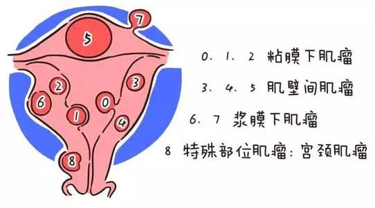 子宮肌瘤留還是不留是否會影響懷孕