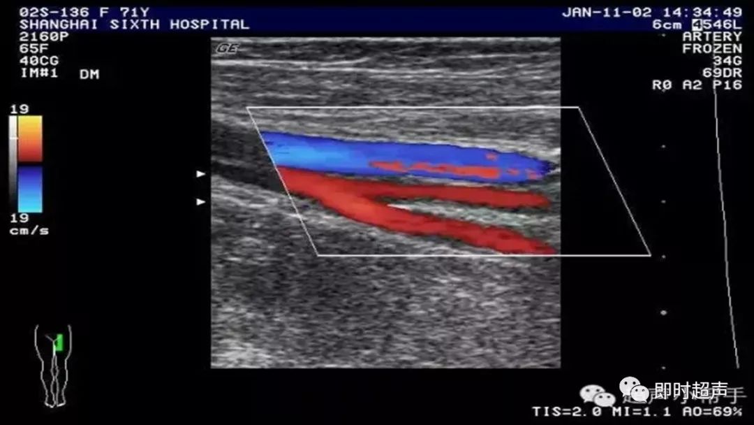 上肢血管解剖图超声图片