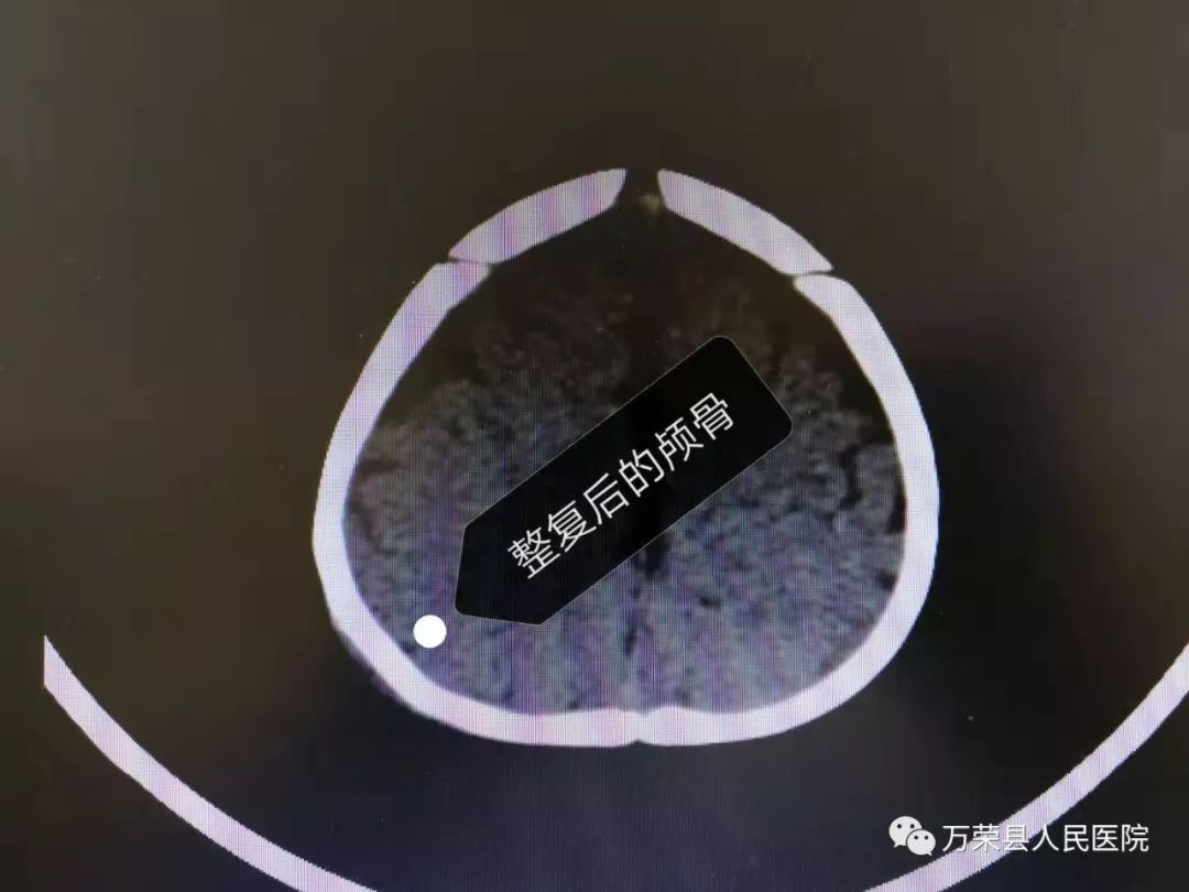 万荣县人民医院神经外科成功为一名临猗籍患儿实施颅骨凹陷骨折微创
