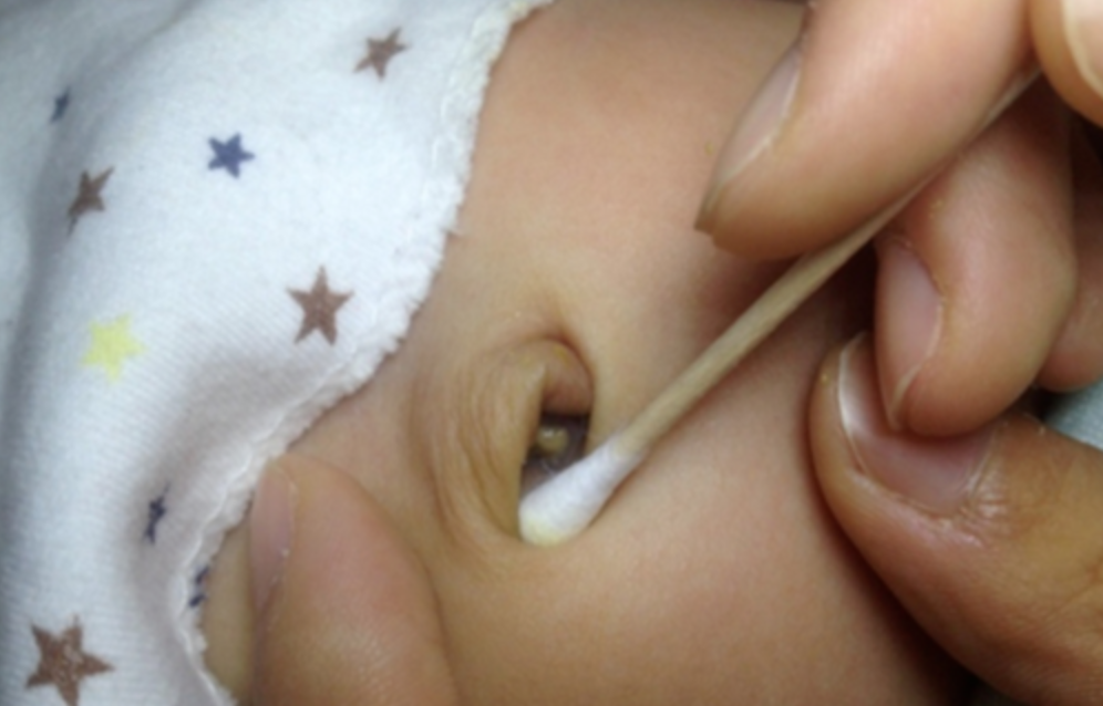 新生儿肚脐护理新生儿脐带脱落和护理方法经验分享