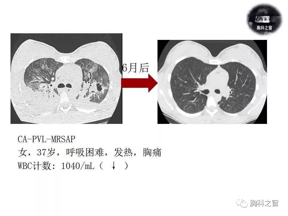 感染性炎症,肺结核甚至肿瘤性疾病鉴别四,总结吸入性sap,尤其是mrsap