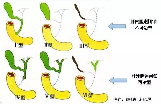 胆道闭锁图片恶化图片