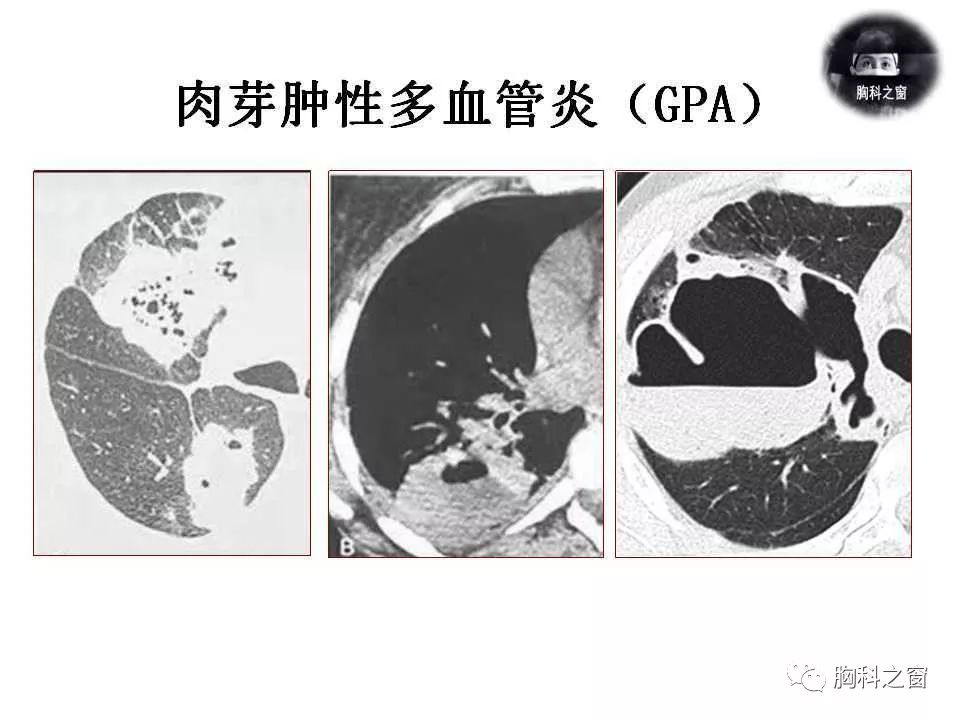 四,总结吸入性sap,尤其是mrsap,影像学表现较具特点,但多数情况下缺乏