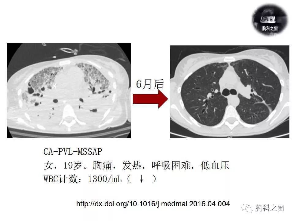 感染性炎症,肺结核甚至肿瘤性疾病鉴别四,总结吸入性sap,尤其是mrsap