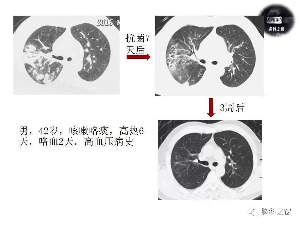 金黄色葡萄球菌肺炎的影像学表现