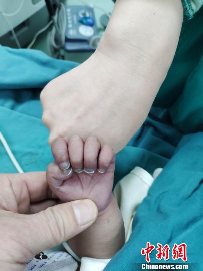 手术前,孩子的嘴巴发紫,小手的指甲发乌 张祖国 摄中新网武汉3月6日电
