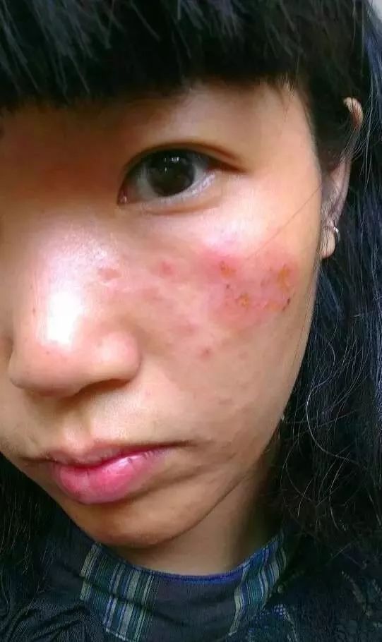 美女脸上湿疹吃3个月松花粉调理,康复了80%