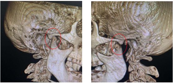 颞下颌关节由下颌骨的一对髁状突(又称下颌小头)和颅底的一对颞骨下颌