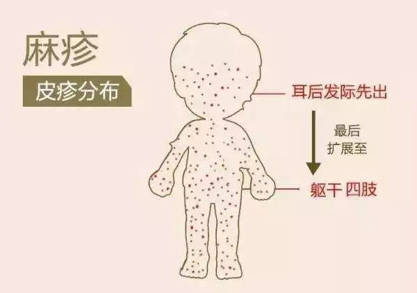 【健康教育】三月防病提示——麻疹和风疹