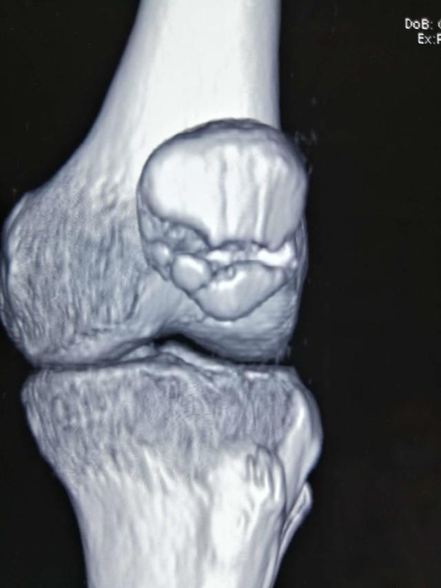 髌骨骨折髌骨爪图片图片