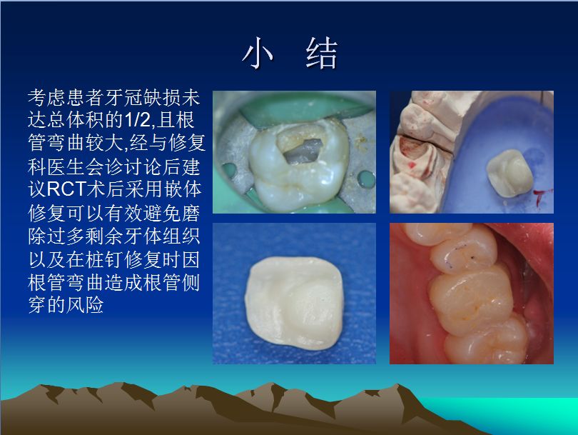 右上頜第一磨牙rct治療一例賞析第三屆薩尼藍色夢想杯根管大賽